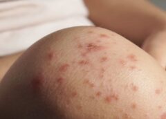 Alerta sanitaria: México registra 28 muertes por sarampión en 2026; CDMX reporta primer deceso